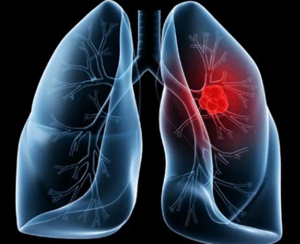 Saiba o que é adenocarcinoma pulmonar, câncer que atinge o papa